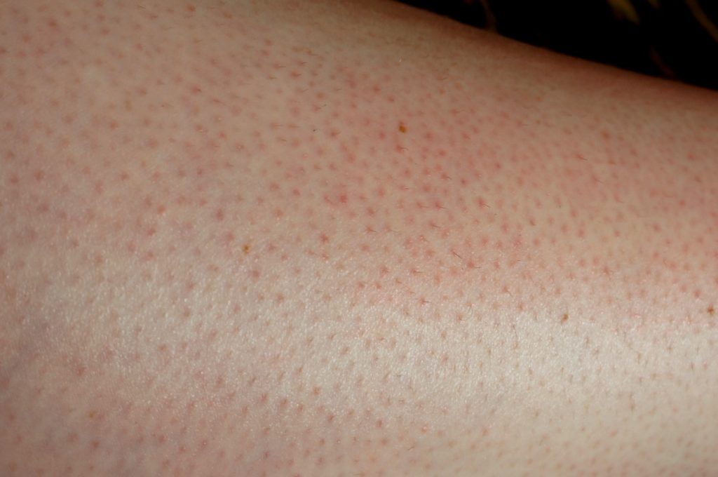 Boutons après épilation : comment s’en débarrasser ?