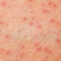 Atténuer les boutons rouges qui grattent après l’épilation ?