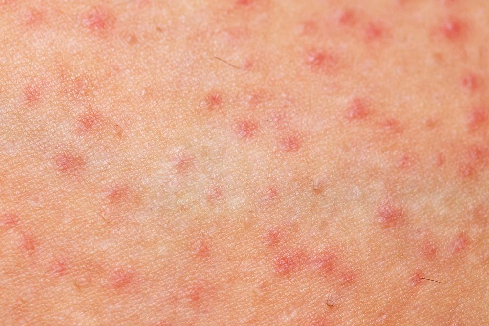 Comment éviter les boutons rouges