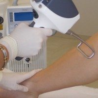 Épilation définitive : laser ou lumière pulsée ?