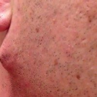 Comment éviter les poils incarnés